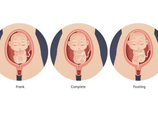 10 vị trí ngôi thai không thuận có thể được chỉ định sinh mổ