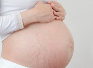 Chống rạn da khi mang thai