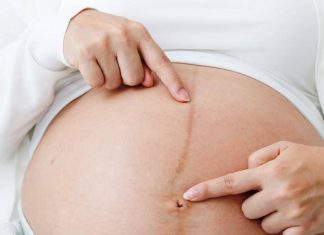 Vạch đen giữa bụng bầu từ đâu mà có?